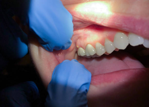 Best Emergency Wisdom Teeth Removal in Glendale, OH