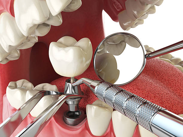 Best Emergency Broken Tooth Repair in Glendale, OH